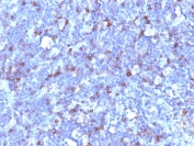 IHC: Formalin-fixed, paraffin-embedded human lymphoma stained with CD43 antibody (clone SPN/1094).