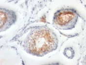 IHC: Formalin-fixed, paraffin-embedded human testicular carcinoma stained with CD147 antibody (BSG/963).