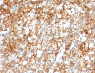 IHC: Formalin-fixed, paraffin-embedded human renal cell carcinoma stained with CD147 antibody (BSG/963).~