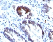 IHC: Formalin-fixed, paraffin-embedded human colon carcinoma stained with SM22 antibody (TAGLN/247)