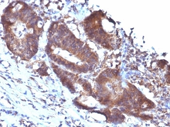 IHC: Formalin-fixed, paraffin-embedded human colon carcinoma stained with SM22 antibody (TAGLN/247)~