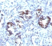IHC: Formalin-fixed, paraffin-embedded human colon carcinoma stained with Transgelin antibody (SPM606).