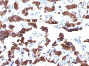 IHC: Formalin-fixed, paraffin-embedded human thyroid carcinoma stained with TG antibody (TGB24).