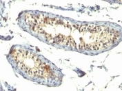 IHC: Formalin-fixed, paraffin-embedded human testicular carcinoma stained with TGF-alpha antibody (TG86 + P/T1).