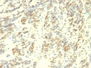 IHC: Formalin-fixed, paraffin-embedded human Leiomyosarcoma stained with Transglutaminase 2 antibody.