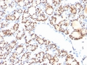 IHC: Formalin-fixed, paraffin-embedded human thyroid stained with TTF-1 antibody (NX2.1/690)