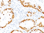 IHC: Formalin-fixed, paraffin-embedded human lung Adenocarcinoma stained with TTF-1 antibody (NX2.1/690)