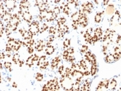 IHC: Formalin-fixed, paraffin-embedded human thyroid stained with TTF-1 antibody (8G7G3/1 + NX2.1/690)