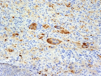 IHC: Formalin-fixed, paraffin-embedded human Erdheim Chester disease (also known as polyostotic lerosing histiocytosis) stained with TNF alpha antibody (clone TNFA/1172).~
