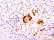 IHC: Formalin-fixed, paraffin-embedded human Erdheim Chester disease (also known as polyostotic sclerosing histiocytosis) stained with TNF-a antibody (clone P/T2).