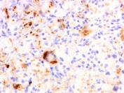 IHC: Formalin-fixed, paraffin-embedded human Erdheim Chester disease (also known as polyostotic sclerosing histiocytosis) stained with TNFa antibody (clone TNF706).