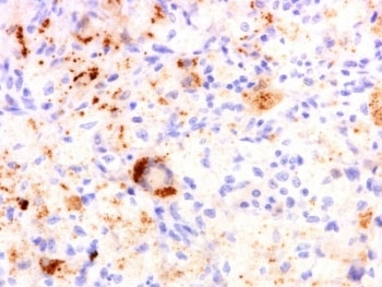 IHC: Formalin-fixed, paraffin-embedded human Erdheim Chester disease (also known as polyostotic sclerosing histiocy
