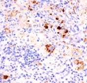 IHC: Formalin-fixed, paraffin-embedded human Erdheim Chester disease (also known as polyostotic sclerosing histiocytosis) stained with TNF alpha antibody (TNF706 + P/T2).