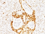 IHC: Formalin-fixed, paraffin-embedded human colon carcinoma stained with p53 antibody (TRP/817)