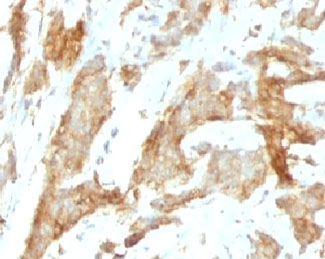 IHC analysis of formalin-fixed, paraffin-embedded human breast carcinoma stained with gp96 antibody (SPM249).~