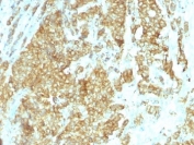 IHC: Formalin-fixed, paraffin-embedded human breast carcinoma stained with GRP94 antibody (clone HSP90B1/1192).