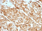 IHC: Formalin-fixed, paraffin-embedded melanoma stained with Tyrosinase antibody (clone OCA1/812).