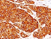 IHC: Formalin-fixed, paraffin-embedded melanoma stained with TYR antibody (clones T311 + OCA1/812).