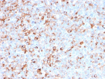 IHC: Formalin-fixed, paraffin-embedded melanoma stained with TYR antibody (T311 + OCA1/812).~