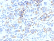 IHC: Formalin-fixed, paraffin-embedded human melanoma stained with TYRP1 antibody (clone TYRP1/807). Required HIER: boil tissue sections in 10mM Tris with 1mM EDTA, pH 9, for 10-20 min followed by cooling at RT for 20 min.