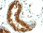 IHC: Formalin-fixed, paraffin-embedded human testicular carcinoma stained with SUMO-1 antibody (SUMO1/1188)