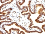 IHC: Formalin-fixed, paraffin-embedded human ovarian carcinoma stained with SUMO-1 antibody (SUMO1/1188)