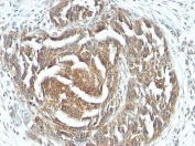 IHC: Formalin-fixed, paraffin-embedded human ovarian carcinoma stained with VEGF antibody (clone VEGF/1063).