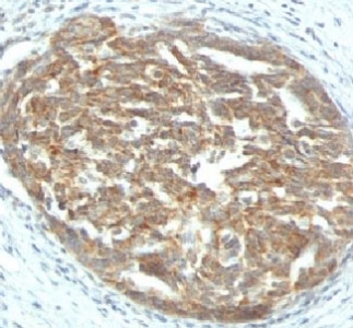 IHC: Formalin-fixed, paraffin-embedded human ovarian carcinoma stained with VEGF antibody (clone SPM225).