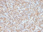 IHC: Formalin-fixed, paraffin-embedded human Ewing's sarcoma stained with anti-Vimentin antibody (clone VM1170).