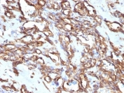 IHC: Formalin-fixed, paraffin-embedded human angiosarcoma stained with anti-Vimentin antibody (clone VM1170).