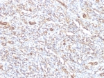 IHC: Formalin-fixed, paraffin-embedded human Rhabdomyosarcoma stained with anti-Vimentin antibody (clone VM1170).