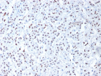IHC testing of FFPE human mesothelioma with Wilms Tumor 1 antibody (clone 6F-H2). Required HIER: boil tissue sections in pH 9 10mM Tris with 1mM EDTA for 10-20 min followed by cooling at RT for 20 min.~