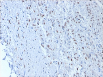 IHC testing of FFPE human mesothelioma with Wilms Tumor 1 antibody (clone SPM361). Required HIER: boil tissue sections in pH 9 10mM Tris with 1mM EDTA for 10-20 min followed by cooling at RT for 20 min.