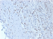 IHC testing of formalin-fixed, paraffin-embedded human kidney stained with Wilms Tumor 1 antibody (clone SPM361).