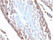 IHC testing of FFPE rat testis with WT1 antibody (clone WT1/857).  Required HIER: boil tissue sections in pH 9 10mM Tris with 1mM EDTA for 10-20 min followed by cooling at RT for 20 min.