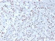 IHC testing of FFPE human mesothelioma with WT1 antibody (clone WT1/857).  Required HIER: boil tissue sections in pH 9 10mM Tris with 1mM EDTA for 10-20 min followed by cooling at RT for 20 min.