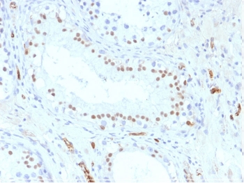 IHC testing of formalin-fixed, paraffin-embedded human testis stained with WT1 antibody (clone WT1/857). Required HIER: boil tissue sections in pH 9 10mM Tris with 1mM EDTA for 10-20 min followed by cooling at RT for 20 min.~