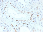 IHC testing of formalin-fixed, paraffin-embedded human testis stained with WT1 antibody (clone WT1/857). Required HIER: boil tissue sections in pH 9 10mM Tris with 1mM EDTA for 10-20 min followed by cooling at RT for 20 min.