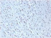 IHC testing of FFPE human mesothelioma with WT1 antibody cocktail (clone WT1/857 + 6F-H2). Required HIER: boil tissue sections in pH 9 10mM Tris with 1mM EDTA for 10-20 min followed by cooling at RT for 20 min.
