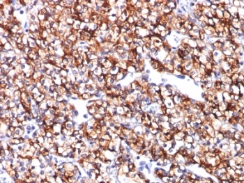 IHC: Formalin-fixed, paraffin-embedded human renal cell carcinoma stained with CAIX antibody (CA9/781).~