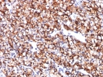 IHC: Formalin-fixed, paraffin-embedded human renal cell carcinoma stained with CAIX antibody (CA9/781).