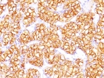 IHC: Formalin-fixed, paraffin-embedded human renal cell carcinoma stained with Carbonic Anhydrase 9 antibody (PN-15).