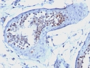 IHC: Formalin-fixed, paraffin-embedded human testicular carcinoma stained with Cyclin B1 antibody.