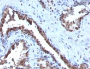 IHC: Formalin-fixed, paraffin-embedded human prostate carcinoma stained with Cyclin B1 antibody.