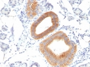 IHC: Formalin-fixed, paraffin-embedded human melanoma stained with CD86 antibody (clone C86/1146).