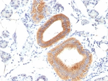 IHC: Formalin-fixed, paraffin-embedded human melanoma stained with CD86 antibody (clone C86/1146).