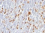 IHC: Formalin-fixed, paraffin-embedded human Hodgkin's lymphoma stained with CD30 antibody (clone Ber-H2). HIER: boil tissue sections in pH 9 10mM Tris with 1mM EDTA for 20 min and allow to cool before testing.