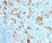 IHC testing of formalin-fixed, paraffin-embedded human Hodgkin's lymphoma stained with CD30 antibody (clone SPM121).