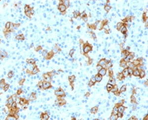 IHC testing of formalin-fixed, paraffin-embedded human Hodgkin's lymphoma stained with CD30 antibody (clone Ki-1/779).~