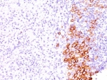 IHC: Formalin-fixed, paraffin-embedded human Hodgkin's lymphoma stained with CD30 antibody (SPM609).